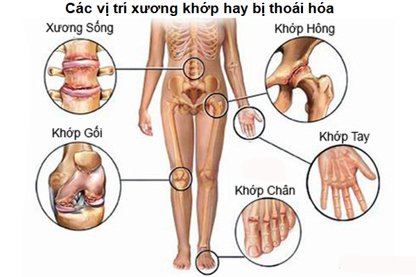 Người mắc bệnh xương khớp ở Việt Nam chiếm tỉ lệ rất cao