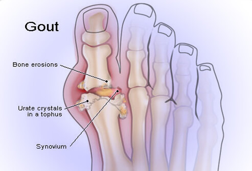 bệnh gout là gì?