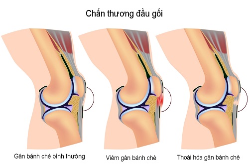 Viêm gân gây đau đớn dai dẳng