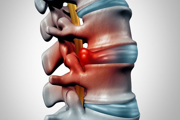 Thoát vị đĩa đệm nguy hiểm nếu để bệnh kéo dài