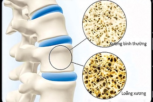 Loãng xương làm mất đi cấu trúc bền vững cho xương