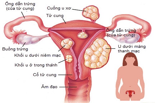 Các chứng bệnh phụ khoa sẽ gây đau lưng thắt ở nữ giới