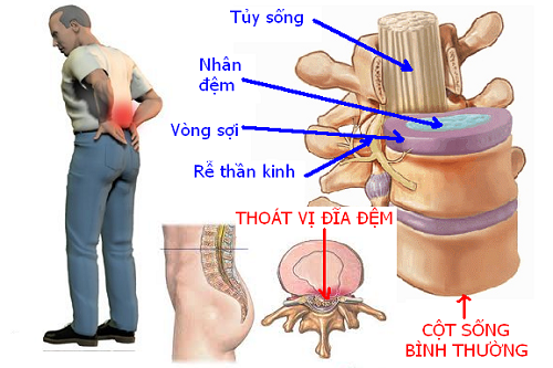 Thoát vị đĩa đệm gây đau đớn cho người bệnh