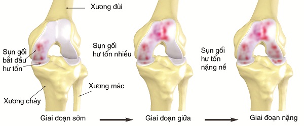 Thoái hóa khớp gối thường diễn ra theo 3 giai đoạn
