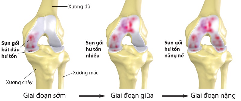 Glucosamine giúp phục hồi các sụn khớp bị tổn thương, thoái hóa