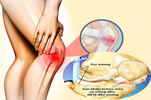 Gai khớp gối có nhiều triệu chứng đau nhức khó chịu