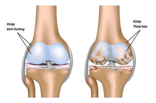Thoái hóa khớp gối kêu theo tiếng kêu lục cục