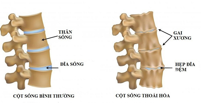 Cột sống bị thoái hóa