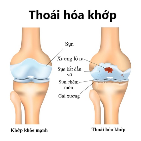 Thoái hóa khớp gối là căn bệnh có tỉ lệ người mắc rất cao