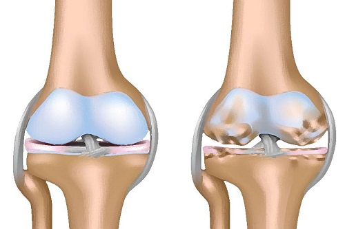 Khớp gối khô cứng do thiếu dịch nhầy bôi trơn