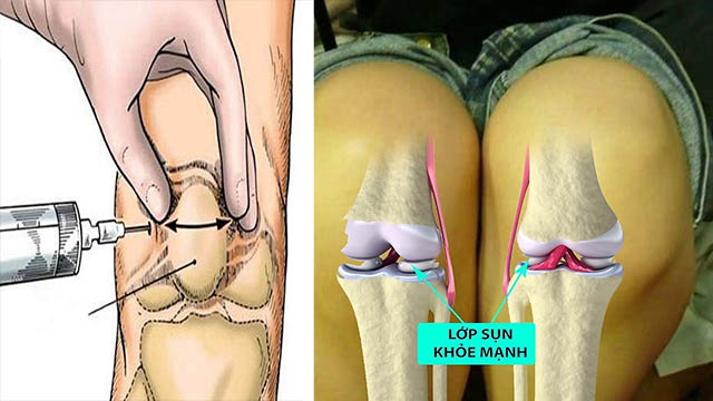 Tiêm Corticoid vào khớp