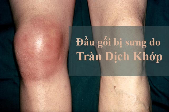 Sưng nề ở khớp gối, một bên gối này sẽ to hơn đầu gối bên còn lại.