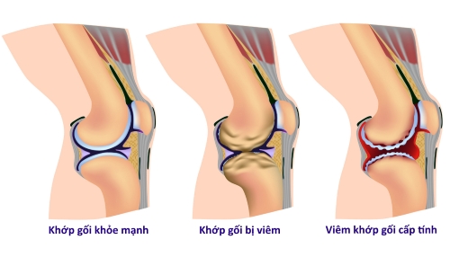 Viêm khớp gây ra đau 1 bên đầu gối