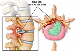 Bệnh thoát vị đĩa đệm là gì? Di chứng do thoát vị đĩa đệm để lại Bệnh thoát vị đĩa đệm là gì? Di chứng do thoát vị đĩa đệm để lại