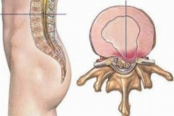 Biểu hiện thường gặp khi bị thoát vị đĩa đệm Biểu hiện thường gặp khi bị thoát vị đĩa đệm