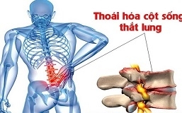 Thoái hóa cột sống thắt lưng nên ăn gì để hạn chế sự tiến triển của bệnh? Thoái hóa cột sống thắt lưng nên ăn gì để hạn chế sự tiến triển của bệnh?